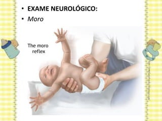 • EXAME NEUROLÓGICO:
• Moro
 