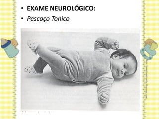 • EXAME NEUROLÓGICO:
• Pescoço Tonico
 