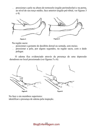 .   pressionar a pele na altura do tornozelo (região perimaleolar) e na perna,
       ao nível do seu terço médio, face anterior (região pré-tibial, ver figuras 3
       e 4).

   .




   Na região sacra:
   . posicionar a gestante de decúbito dorsal ou sentada, sem meias;
   . pressionar a pele, por alguns segundos, na região sacra, com o dedo
      polegar.

     O edema fica evidenciado através da presença de uma depressão
duradoura no local pressionado (ver figuras 5 e 6).




Na face e em membros superiores:
identificar a presença de edema pela inspeção.




                                  53
                         BlogEnfermagem.com
 