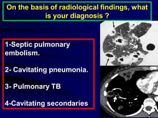 On the basis of radiological findings, what
is your diagnosis ?
1-Septic pulmonary
embolism.
2- Cavitating pneumonia.
3- Pulmonary TB
4-Cavitating secondaries
 