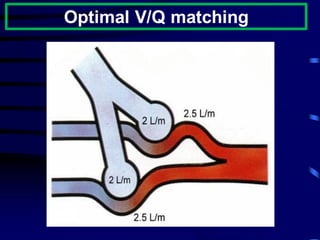 Optimal V/Q matching
 