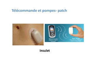 Télécommande et pompes- patch




              Insulet
 