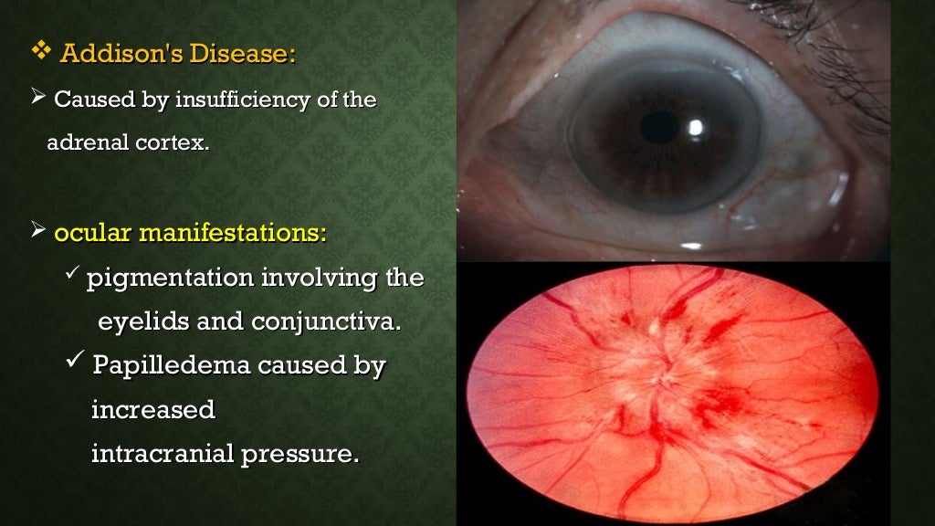 Associated eyes diseases