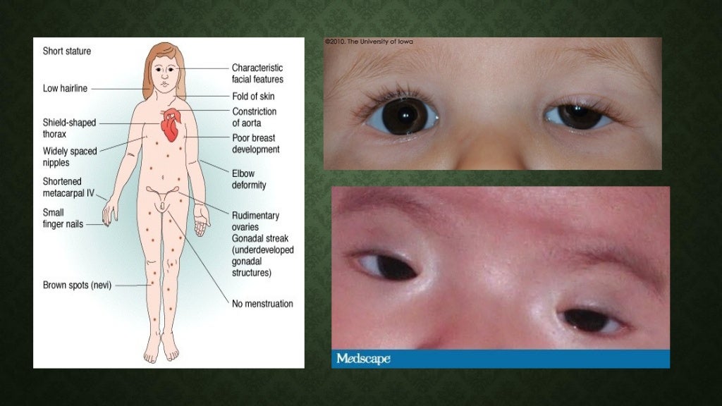 Associated eyes diseases