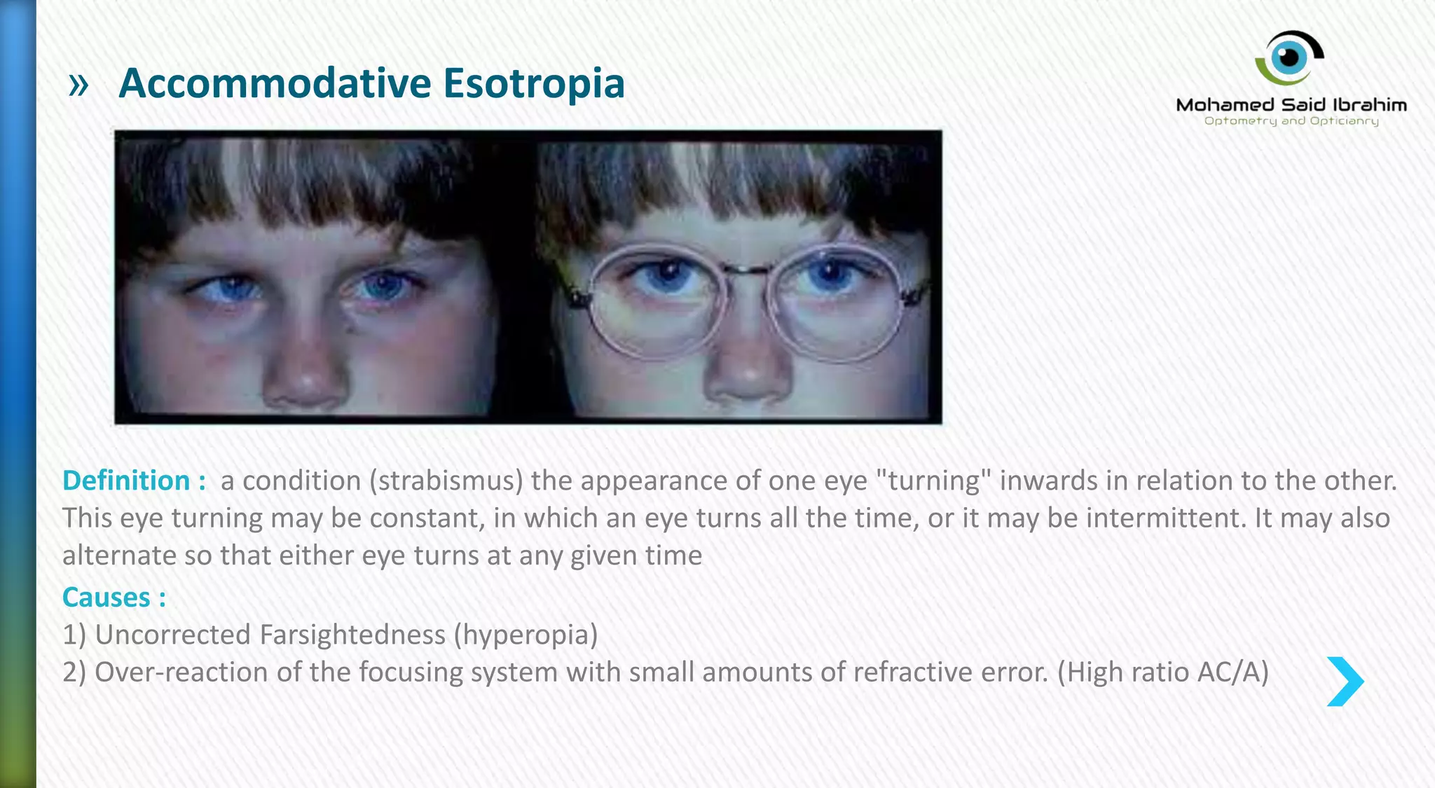 » Accommodative Esotropia
Definition : a condition (strabismus) the appearance of one eye "turning" inwards in relation to the other.
This eye turning may be constant, in which an eye turns all the time, or it may be intermittent. It may also
alternate so that either eye turns at any given time
Causes :
1) Uncorrected Farsightedness (hyperopia)
2) Over-reaction of the focusing system with small amounts of refractive error. (High ratio AC/A)
 