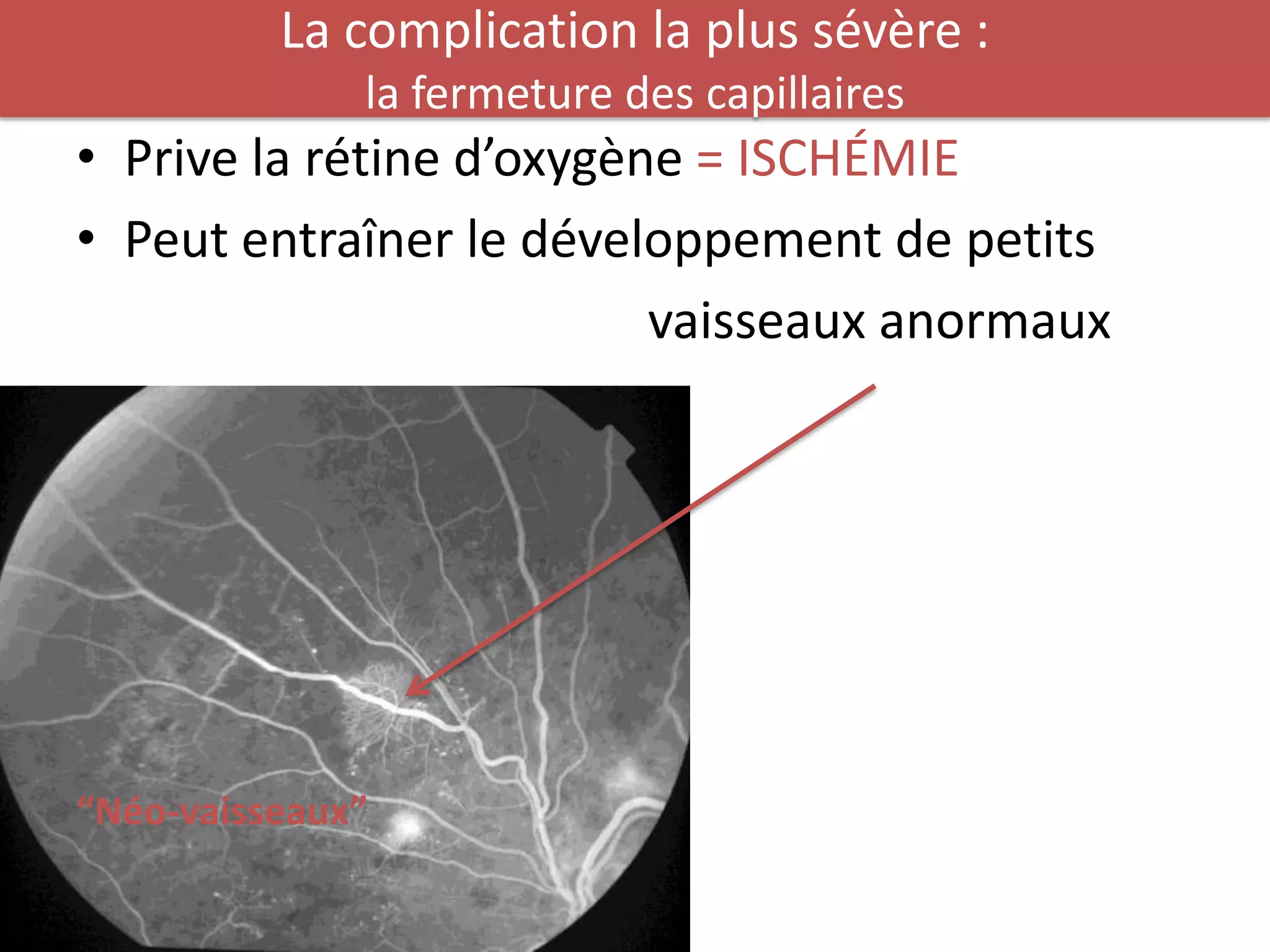 La complication la plus sévère :
              la fermeture des capillaires
• Prive la rétine d’oxygène = ISCHÉMIE
• Peut entraîner le développement de petits
                          vaisseaux anormaux




“Néo-vaisseaux”
 