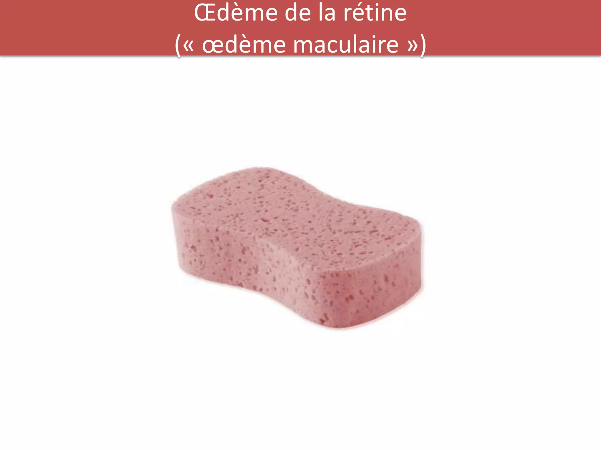 Œdème de la rétine
(« œdème maculaire »)
 