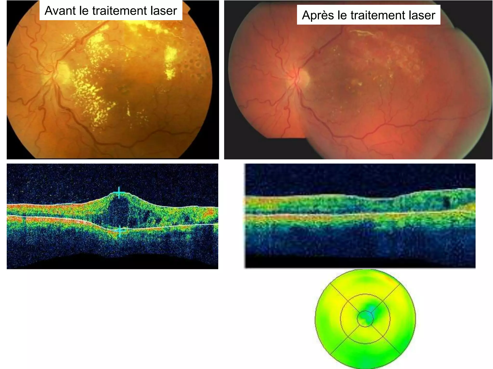 Avant le traitement laser   Après le traitement laser
 