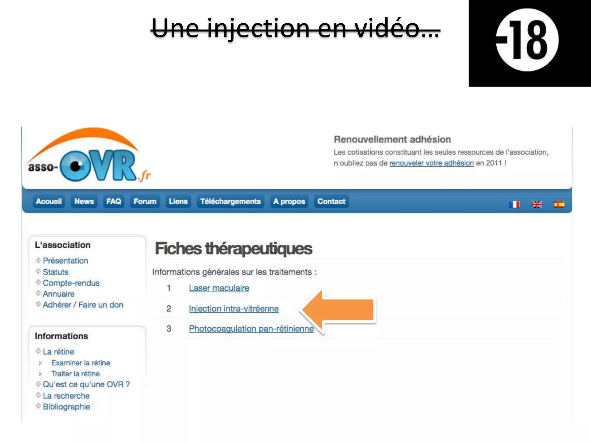 Une injection en vidéo…
 