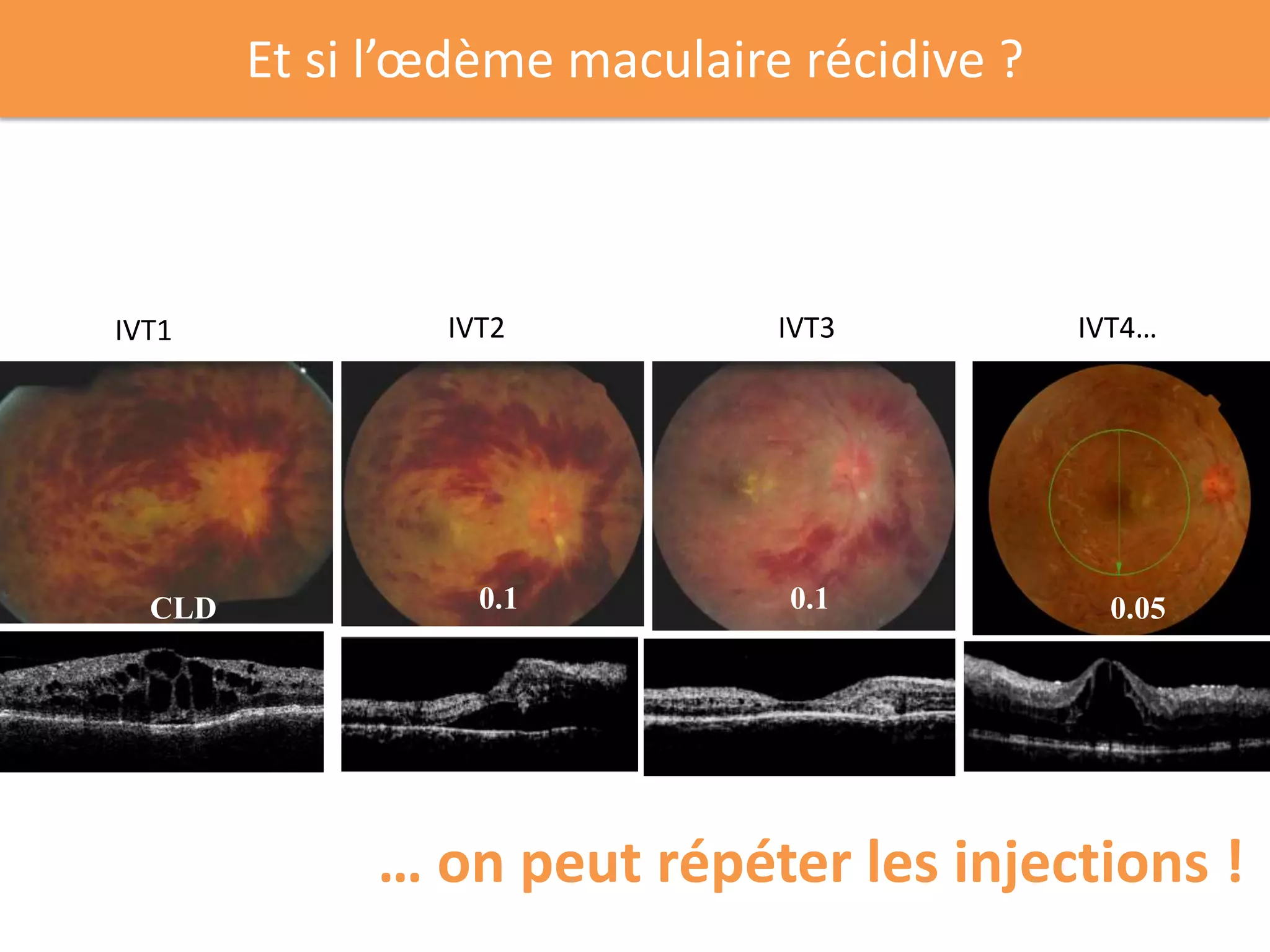 Et si l’œdème maculaire récidive ?



IVT1            IVT2           IVT3          IVT4…




  CLD             0.1          0.1                 0.05
                                             0.1




             … on peut répéter les injections !
 