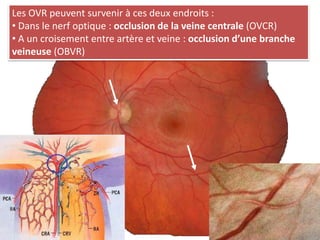Les OVR peuvent survenir à ces deux endroits :
• Dans le nerf optique : occlusion de la veine centrale (OVCR)
• A un croisement entre artère et veine : occlusion d’une branche
veineuse (OBVR)
 