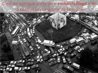 C’est en quelque sorte un « embouteillage » de
       la circulation sanguine de la rétine
 