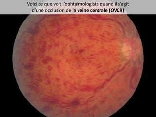 Voici ce que voit l’ophtalmologiste quand il s’agit
  d’une occlusion de la veine centrale (OVCR)
 