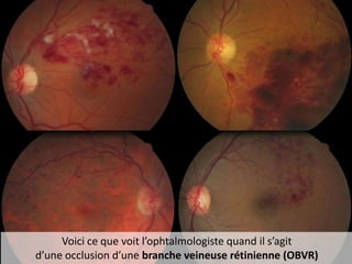 Voici ce que voit l’ophtalmologiste quand il s’agit
d’une occlusion d’une branche veineuse rétinienne (OBVR)
 