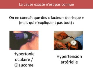 La cause exacte n’est pas connue


On ne connaît que des « facteurs de risque »
     (mais qui n’expliquent pas tout) :




  Hypertonie
                           Hypertension
   oculaire /
                             artérielle
  Glaucome
 
