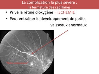 La complication la plus sévère :
              la fermeture des capillaires
• Prive la rétine d’oxygène = ISCHÉMIE
• Peut entraîner le développement de petits
                          vaisseaux anormaux




“Néo-vaisseaux”
 