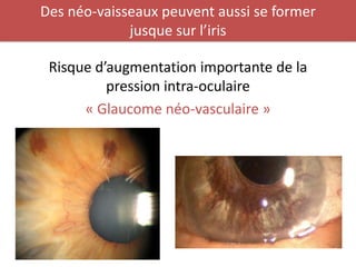 Des néo-vaisseaux peuvent aussi se former
             jusque sur l’iris

 Risque d’augmentation importante de la
          pression intra-oculaire
      « Glaucome néo-vasculaire »
 