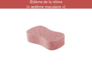 Œdème de la rétine
(« œdème maculaire »)
 