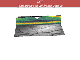 OCT
Tomographie en Cohérence Optique
 