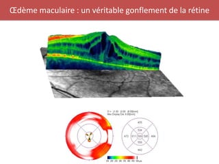 Œdème maculaire : un véritable gonflement de la rétine
 