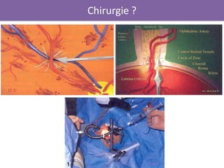 Chirurgie ?
 
