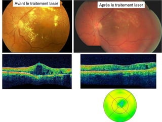 Avant le traitement laser   Après le traitement laser
 