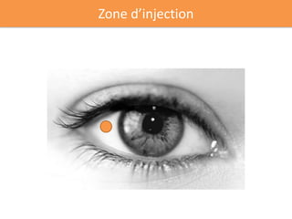 Zone d’injection
 