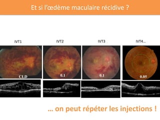 Et si l’œdème maculaire récidive ?



IVT1            IVT2           IVT3          IVT4…




  CLD             0.1          0.1                 0.05
                                             0.1




             … on peut répéter les injections !
 