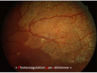 « Photocoagulation pan-rétinienne »
 
