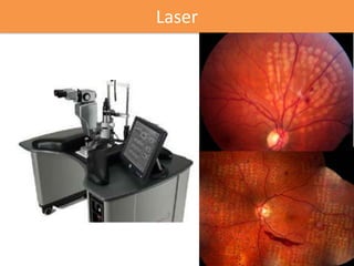 Laser
 