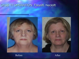 CASE 11 OPERATION: Facelift, NeckliftCASE 11 OPERATION: Facelift, Necklift
Before After
 