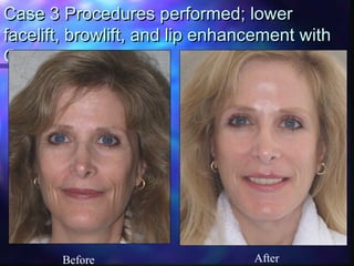 Case 3 Procedures performed; lowerCase 3 Procedures performed; lower
facelift, browlift, and lip enhancement withfacelift, browlift, and lip enhancement with
GortexGortex
Before After
 