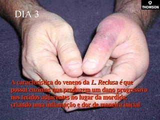 DIA 3 A característica do veneno da  L. Reclusa é  que possui enzimas que produzem um dano progressivo nos tecidos adjacentes no lugar da mordida, criando uma inflamação e dor de maneira inicial  