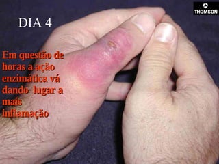 DIA 4 Em questão de horas a ação enzimática vá dando  lugar a mais inflamação  