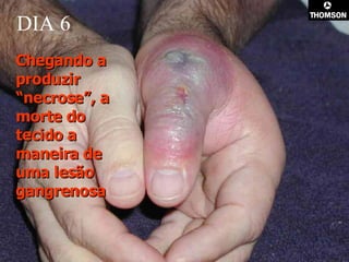 DIA 6 Chegando a produzir “necrose”, a morte do tecido a maneira de uma lesão gangrenosa   