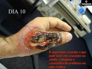 DIA 10 É  importante recordar o que pode fazer este aracnídeo no adulto, e imaginar o catastrófico do problema em uma criança.  