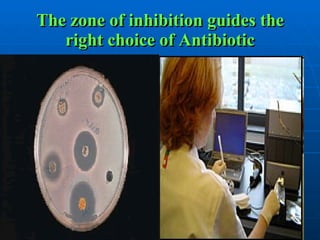 The zone of inhibition guides the right choice of Antibiotic 