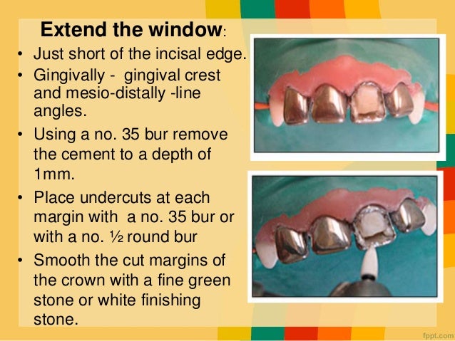 Asthetic Crowns In Pediatric Dentistry
