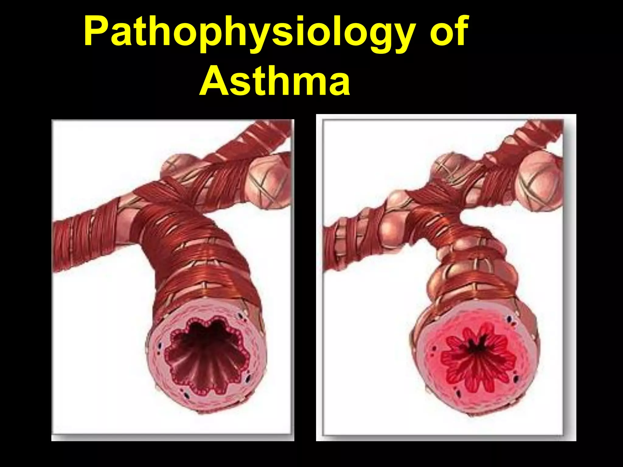Asthma