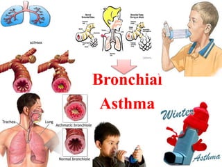 Bronchial
Asthma
 