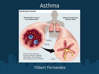 Asthma
Yilbert Fernandez
 