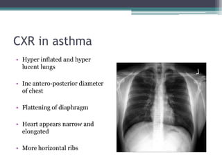 CXR in asthma
• Hyper inflated and hyper
lucent lungs
• Inc antero-posterior diameter
of chest
• Flattening of diaphragm
• Heart appears narrow and
elongated
• More horizontal ribs
 