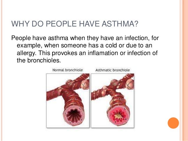 Asthma