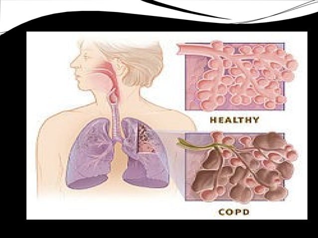 Asthma and COPD | PPT | Lung and Respiratory Health | Diseases and ...