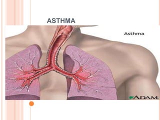 ASTHMA
1
 