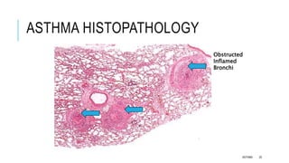 ASTHMA HISTOPATHOLOGY
Obstructed
Inflamed
Bronchi
ASTHMA 20
 