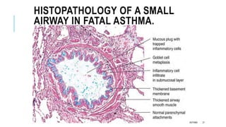 HISTOPATHOLOGY OF A SMALL
AIRWAY IN FATAL ASTHMA.
ASTHMA 21
 
