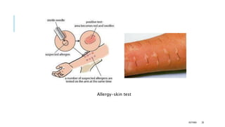 Allergy-skin test
ASTHMA 28
 