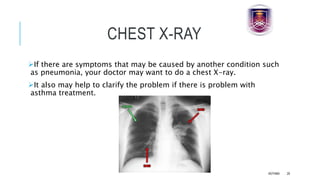 CHEST X-RAY
If there are symptoms that may be caused by another condition such
as pneumonia, your doctor may want to do a chest X-ray.
It also may help to clarify the problem if there is problem with
asthma treatment.
ASTHMA 29
 