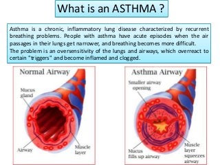 What is an ASTHMA ?
Asthma is a chronic, inflammatory lung disease characterized by recurrent
breathing problems. People with asthma have acute episodes when the air
passages in their lungs get narrower, and breathing becomes more difficult.
The problem is an oversensitivity of the lungs and airways, which overreact to
certain "triggers" and become inflamed and clogged.
 